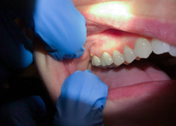 Best Emergency Dental Care for Broken or Chipped Teeth in Lawrencevle, IL